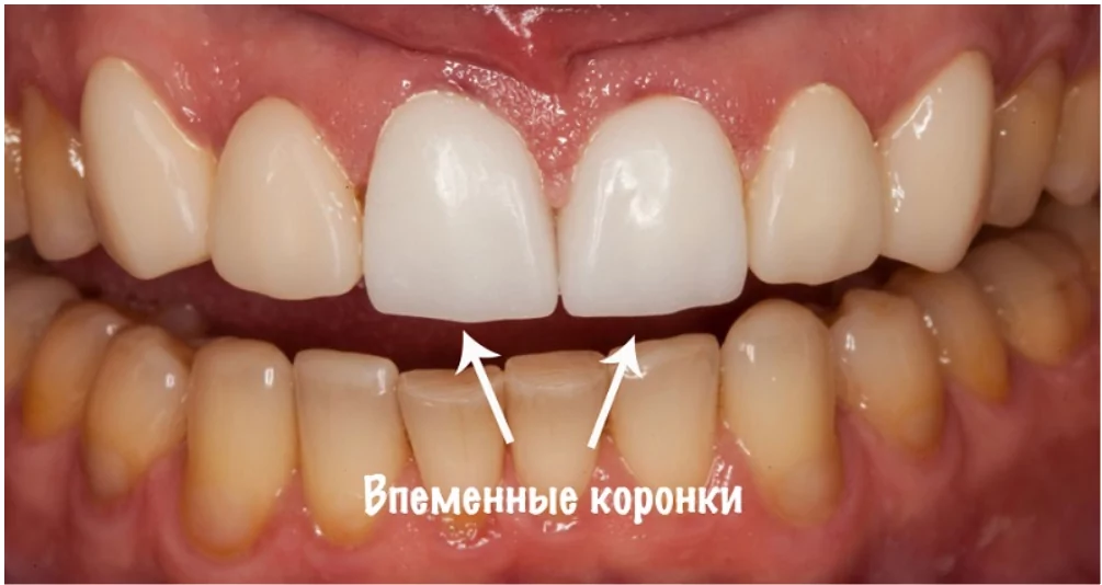 Временный протез на передний зуб