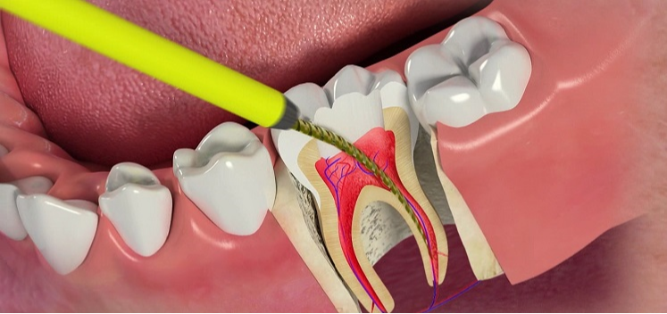 Лечение каналов зуба клиника