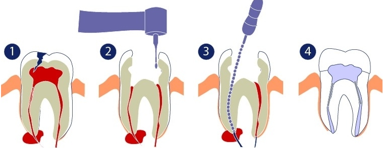 Лечение каналов зуба цена москва