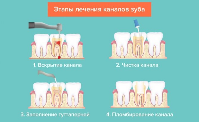 Лечение каналов зуба цена москва