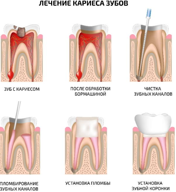 Зубы лечение без анестезии