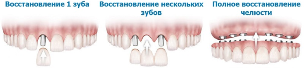 Москва лечение разрушенных зубов