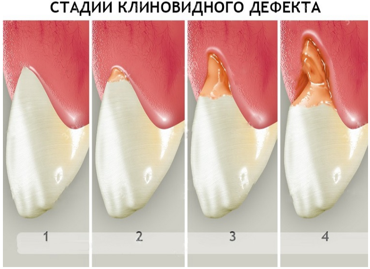 Лечение клиновидного дефекта зубов в москве