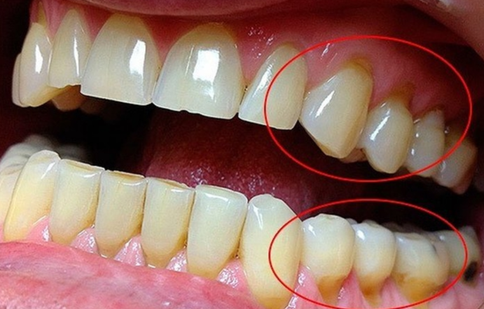 Лечение клиновидного дефекта зубов в москве